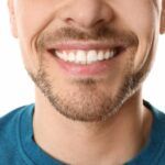 Procedure-dental-veneers