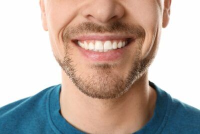 Procedure-dental-veneers