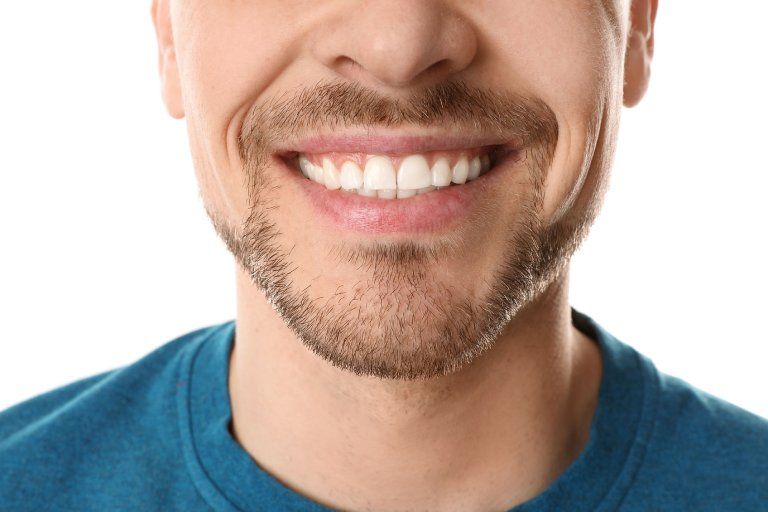 Procedure-dental-veneers