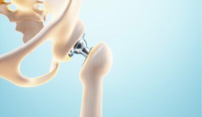 Total-hip-replacement