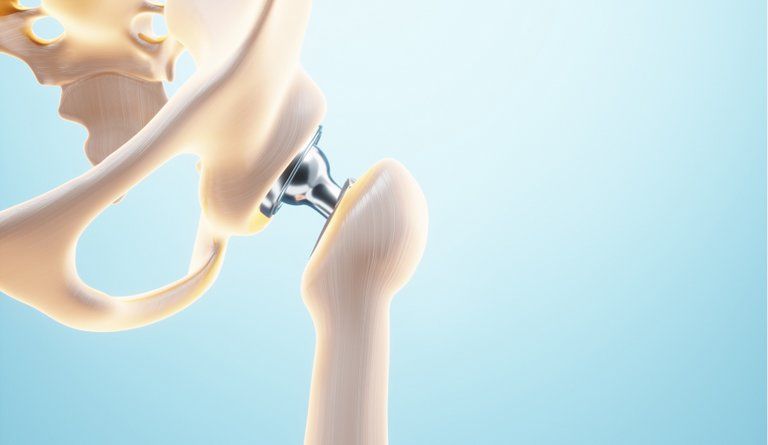 Total-hip-replacement