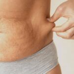 Tummy-tuck