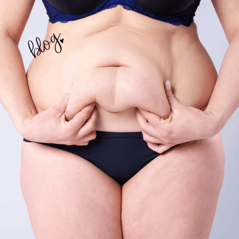 Femme pinçant un excès de peau abdominale avant une abdominoplastie